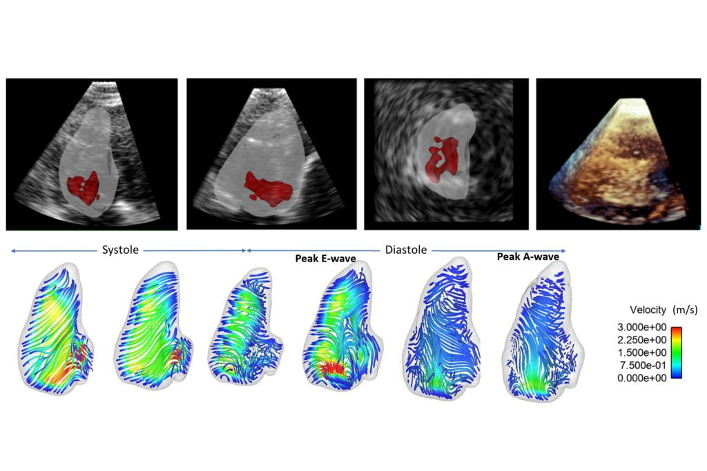 Three-dimensional streamlines of blood flow (below) in the right ventricle of the heart during a heartbeat acquired from 3D echocardiography data. Yasaman Farsiani / UCI