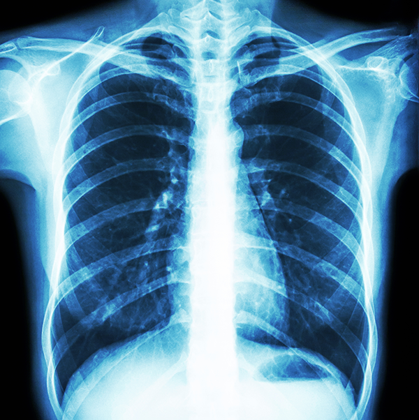 Samueli School engineers are using artificial intelligence, based on COVID-19 patients’ chest X-rays, to help determine disease severity. 