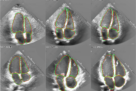 These echocardiogram images show the comparison between the automatic (red) and manual (green) segmentation of all four heart chambers for six typical subjects from the research dataset.