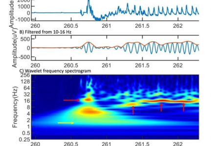 An image from the Scientific Reports paper by UC Irvine researchers shows sleep wave frequencies embedded in a slow wave in a single axon. The top row presents raw data from a feedback axon from the hippocampus’ cornu ammonis 3 region. The middle row shows the same data filtered from 10-16 Hz for spindle events. In the bottom row, spindle frequency hot spots appear in red, while the yellow arrow points to the slow wave near 1 Hz frequency. UCI